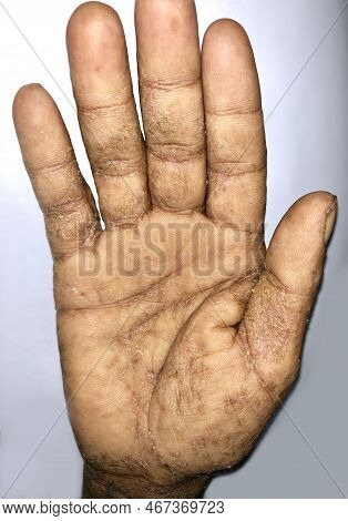 Giant Scabies Infestation Or Norwegian Scabies In Hand Of Southeast Asian, Burmese Man. A Contagious