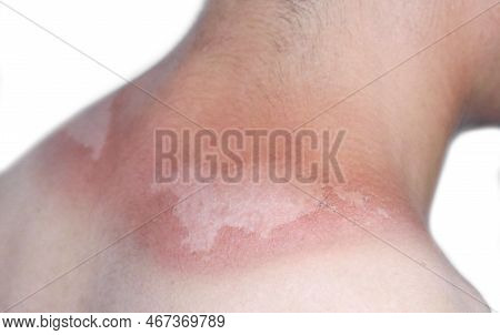 Sunburn Peeling Discoloration Or Sun Burn Dermatitis In The Upper Back Of Asian Young Man.