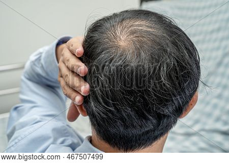 Bald In The Middle Head And Begin No Loss Hair Glabrous Of Mature Asian Business Smart Active Office