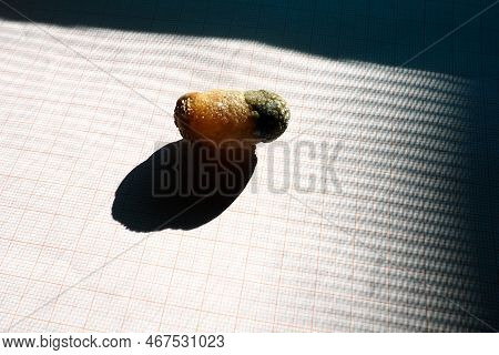 Gallstone Disease, Cholelithiasis - The Formation Of Stones, Stones In The Gallbladder, Bile Ducts. 