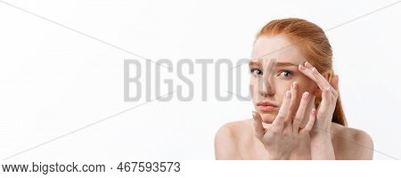 Young Caucsian Woman Squeezes Acne On The Face Of Beauty