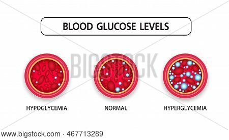 Hyperglycemia, High Blood Sugar And Diabetes ,obesity Is A Serious Medical Condition Causes, Vector 