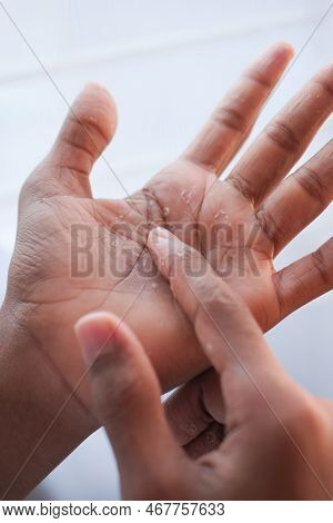 Close Up Of Dry Cracked Skin Of A Mens Hand
