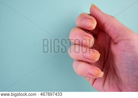 Damaged And Yellowed Nails Of A Woman On A Blue Background.copy Space.