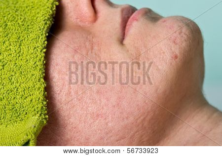 Acne Treatment