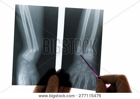 The Doctor Holds A Pointer In His Hand And Shows A Fracture In The Picture. Isolated X-ray Of The Ra