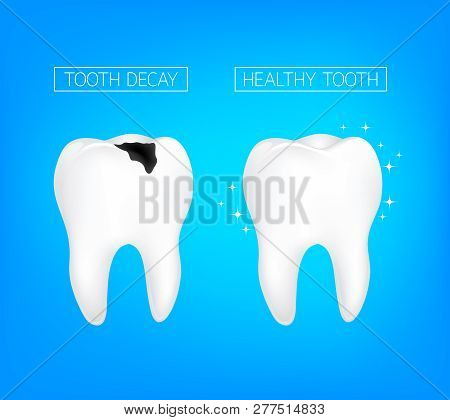 Caries And Healthy Tooth Comparision. Dental Care Concept,  Oral Care, Teeth Restoration. Illustrati