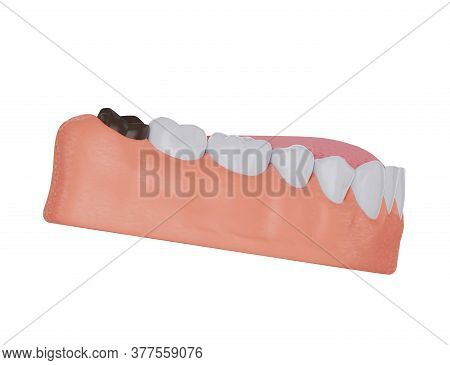 Brown Affected Wisdom Tooth, Caries, Dark Tooth. A New Wisdom Tooth Has Come Out Of The Gum Already 