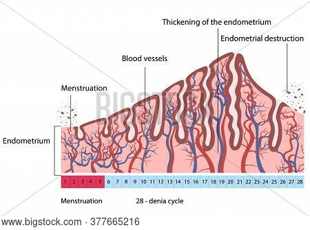 Vector Illustration Of Changes In Uterine Endometrial Destruction. Menstrual Cycle.