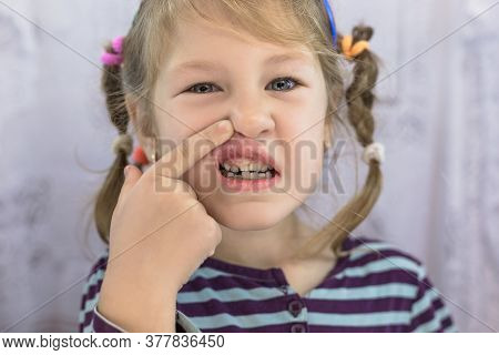 Adult Permanent Teeth Coming In Front Of The Child's Baby Teeth: Shark Teeth. Little Girl's Open Mou