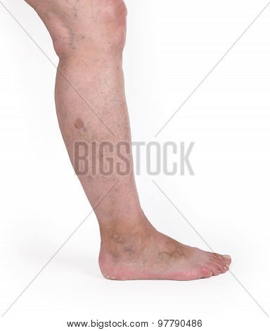 Old Woman With Varicose Veins