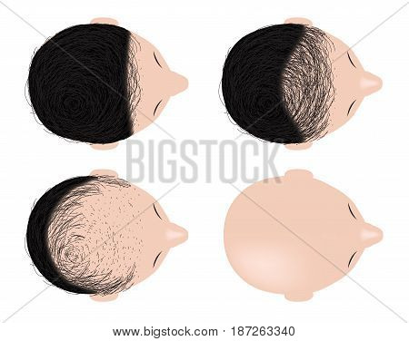 type of baldness , bald head vector . no hair
