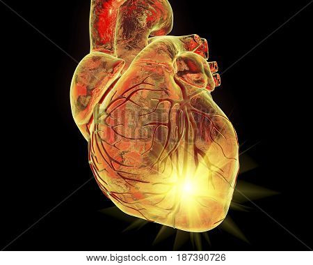 Heart attack, conceptual image for heart diseases. 3D illustration