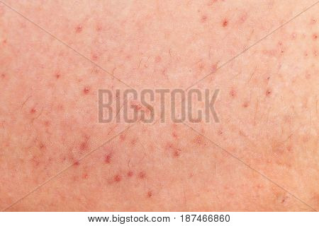 Close up picture of folliculitis on human skin