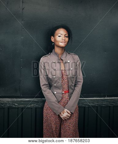 Beautiful Young Brunette Woman With Vitiligo Disease