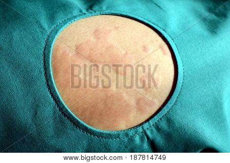 Skin rash Urticaria Allergic skin reaction. Pathology.
