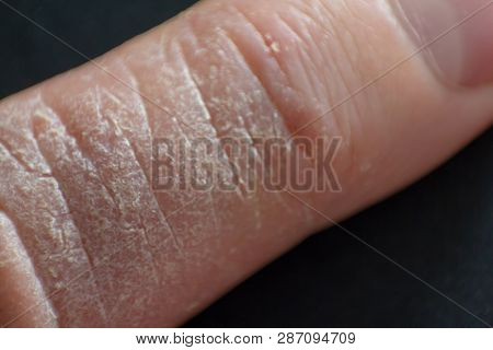 Hand Dermatitis. Hand Eczema Closed On Black Background