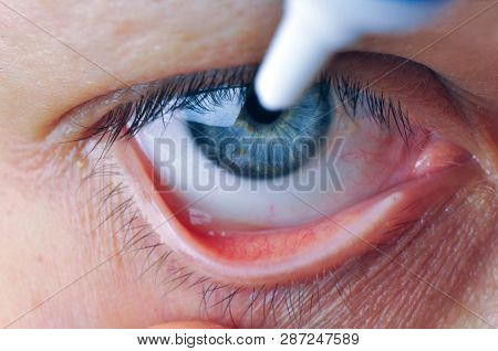 Implementation Drug In Conjunctival Sac. Instill Eye Ointment.