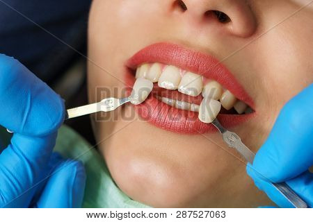 Teeth Whitening At Dentist. Young Girl Shows Her Teeth. White Teeth. Dentist Picks Up Shade Of Ename