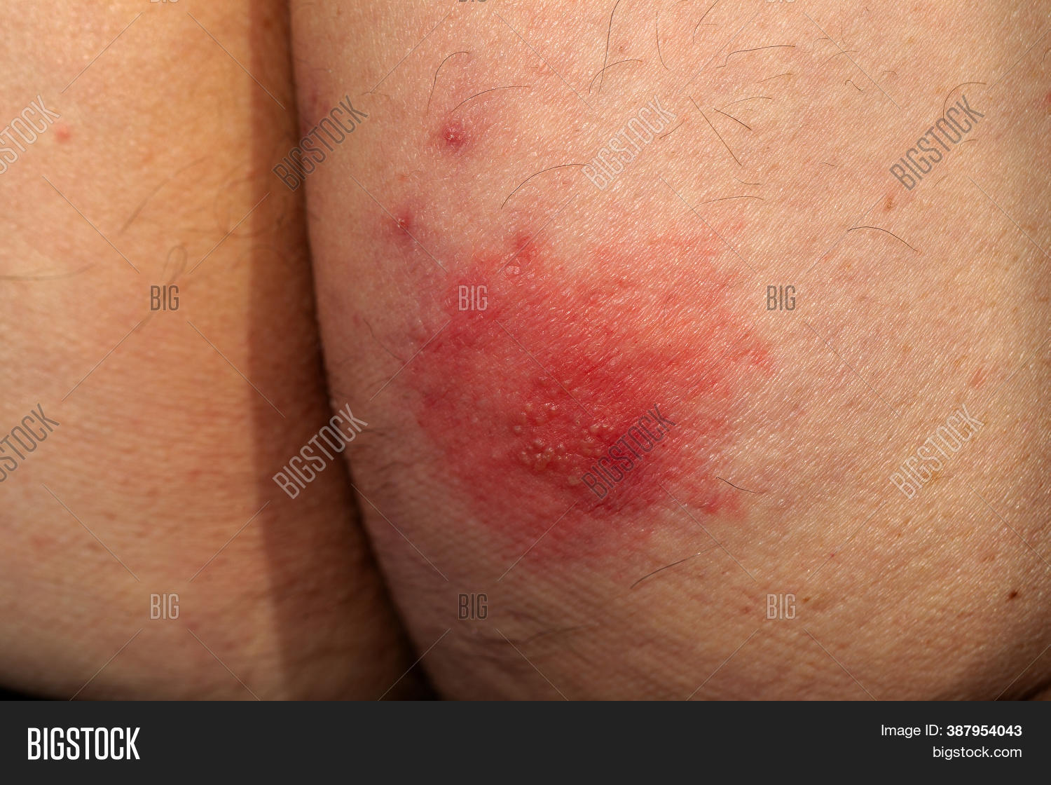 Shingles (disease). Image & Photo (Free Trial) | Bigstock