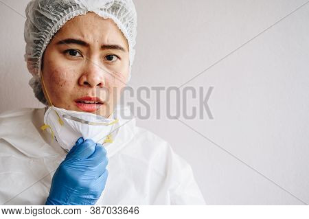 Healthcare Worker With Acne And Facial Wounds Occur From A Medical Mask After Work For A Longtime In