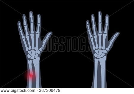 X Ray Of Arm Fracture With Red Pain Point And Normal Arm. Broken Hand With Inner Closed Greenstick T