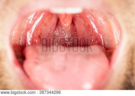 Inflamed Throat Of A Person Affected By An Infection Very Close-up.