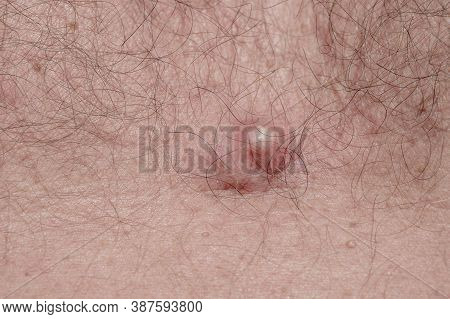 Acne On Body Skin, Dermatological Disease Acne, Closeup