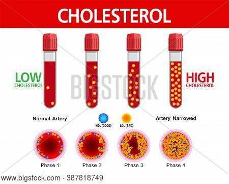 Cholesterol In Artery, Health Risk , Vector Design.