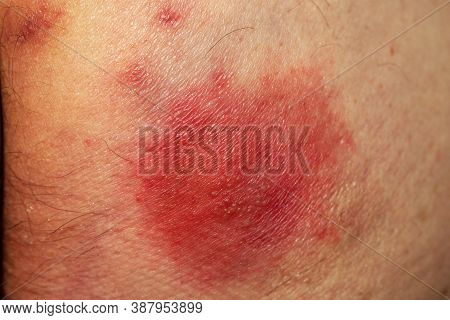 Shingles (disease). Sympton Of The Herpes Virus On The Human Body. Skin Rash And Blisters On The Bod