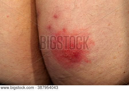 Shingles (disease). Sympton Of The Herpes Virus On The Human Body. Skin Rash And Blisters On The Bod