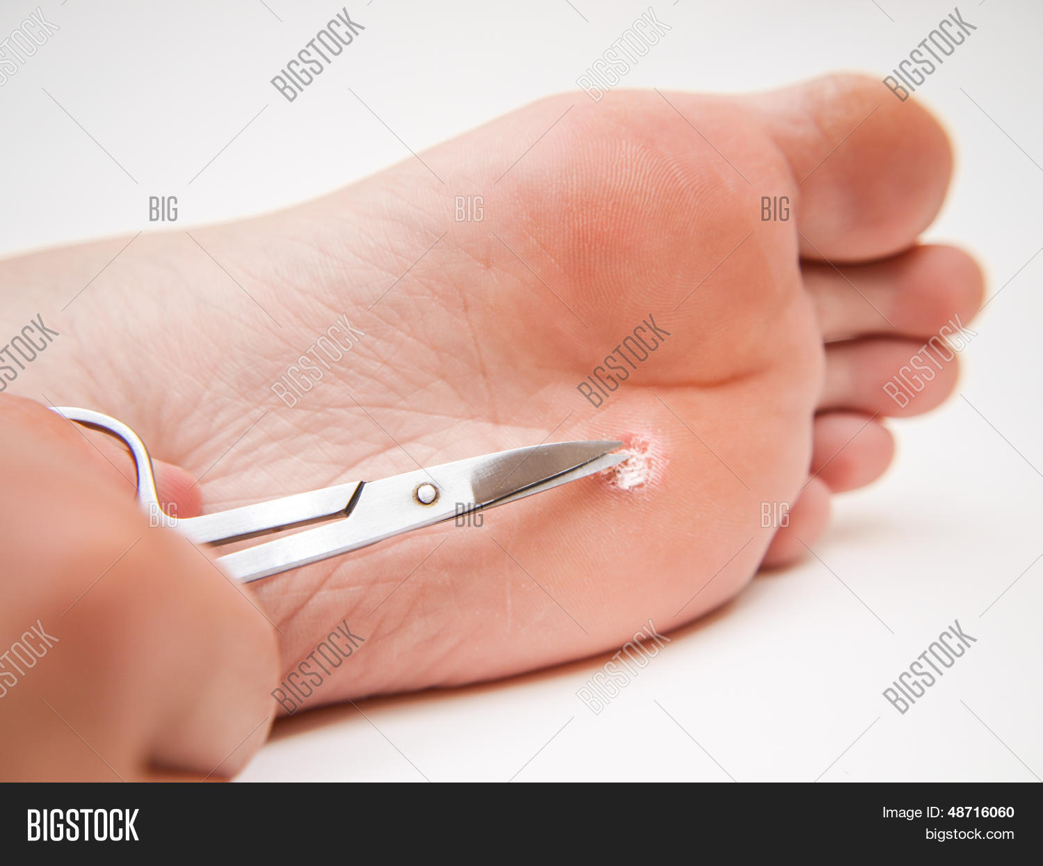 callosity foot treatment