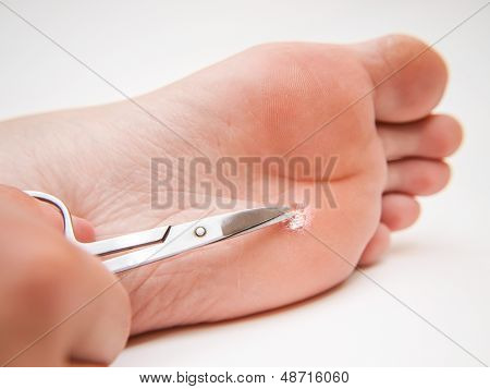 Callus ใต้เท้า