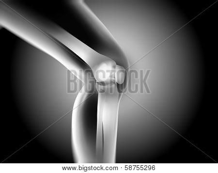 x ray of knee showing knee pain