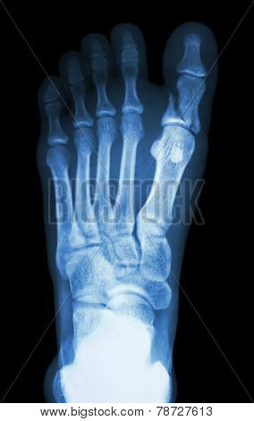 Fracture Proximal Phalange At First Toe