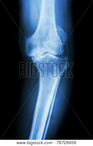 Osteoarthritis Knee Patient