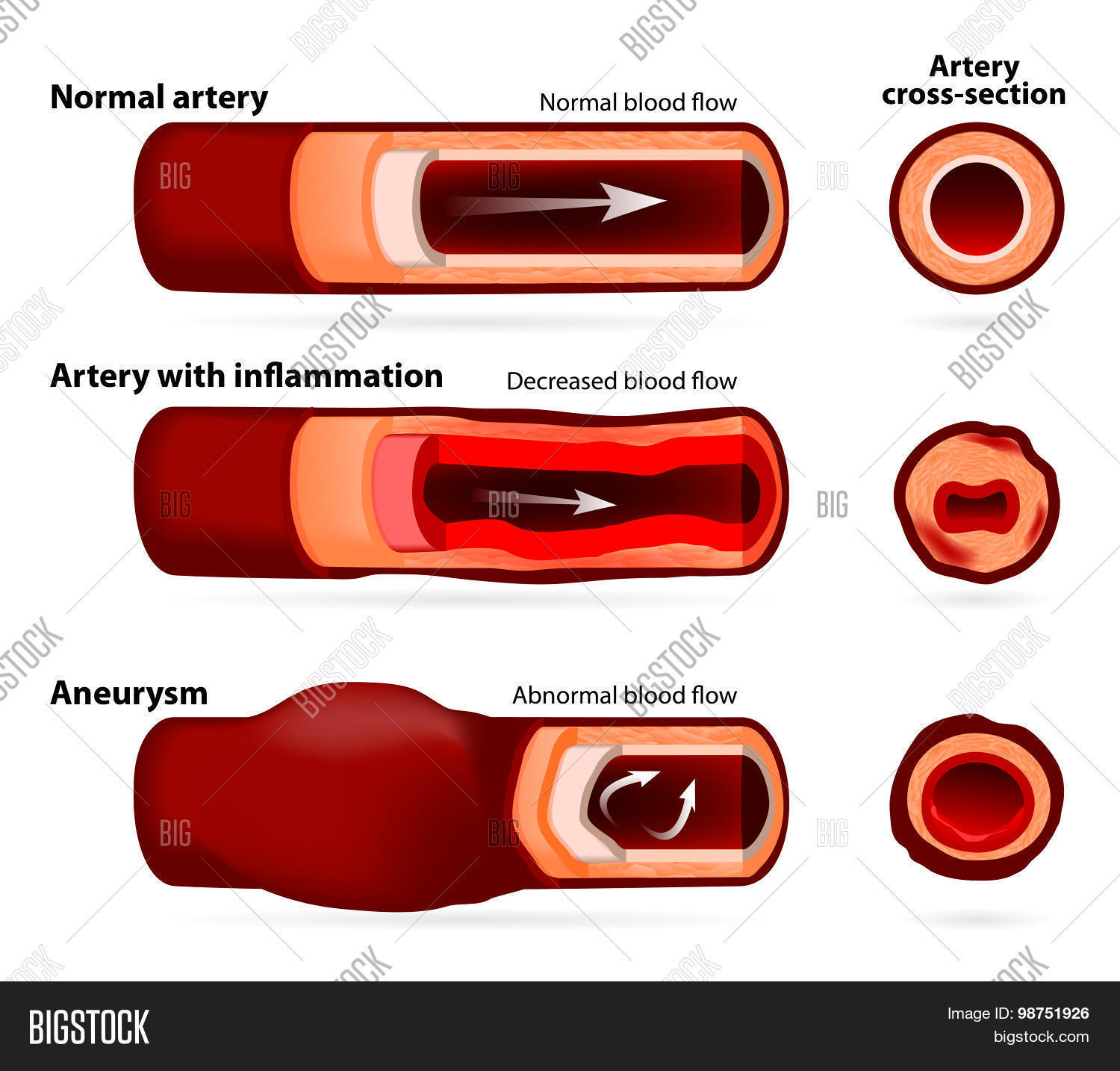 Normal Artery, Vector & Photo (Free Trial) Bigstock
