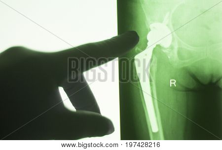 Hip Joint Replacement Impant