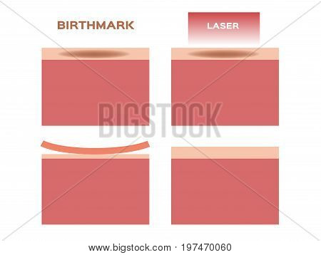 laser remove the birthmark vector on white background
