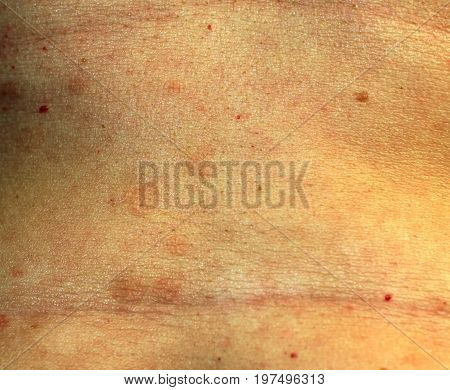 Red Flat Lichen planus. Red spots on the skin of the abdomen.