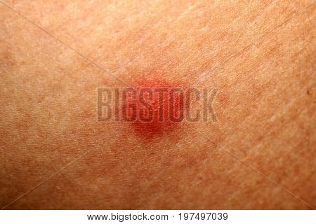 Red mosquito bites. Swelling of the skin. A bite of a wasp, a bee