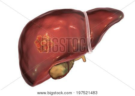 Liver cancer. 3D illustration showing presence of tumor inside liver