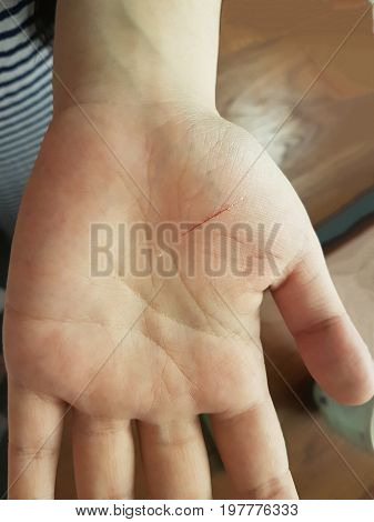 Foreground image of a cut on palm with blur background