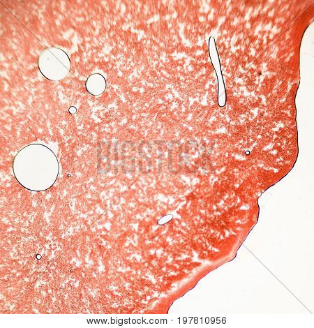 Blood Smear Under Microscope Present Neutrophils And Red Blood Cells. Photo Micro Sections With High