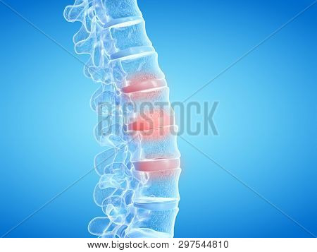 3d rendered medically accurate illustration of painful intervertebral discs