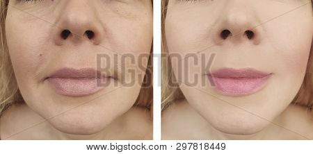 Female Eyes Wrinkles Before And After Regeneration Procedures