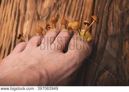 Foot With Mushrooms On The Nail Plate On A Wooden Background. Concept Of Fungal Diseases Of The Nail
