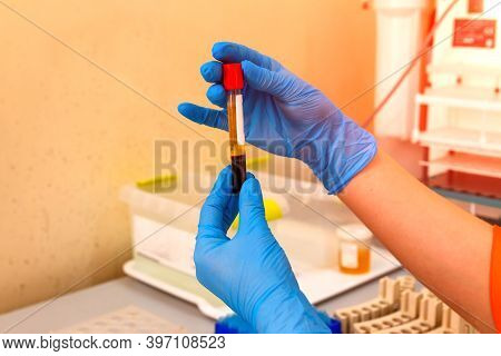 Blood Tube In Hands. Test For Analysis In The Laboratory Of Hematology. Illness Diagnosing. Selectiv