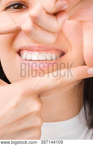 Smiling Woman In Clear And Invisible Aligners Making A Frame By Hands.