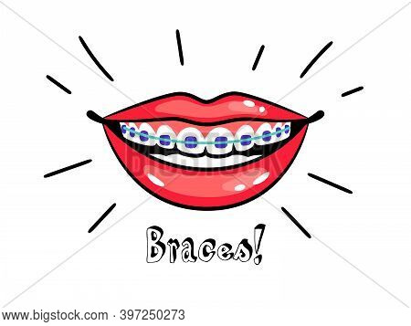 Orthodontic Braces. Cartoon Smile With Dental Braces, Correct Bite Of Teeth, Vector Illustration Of 